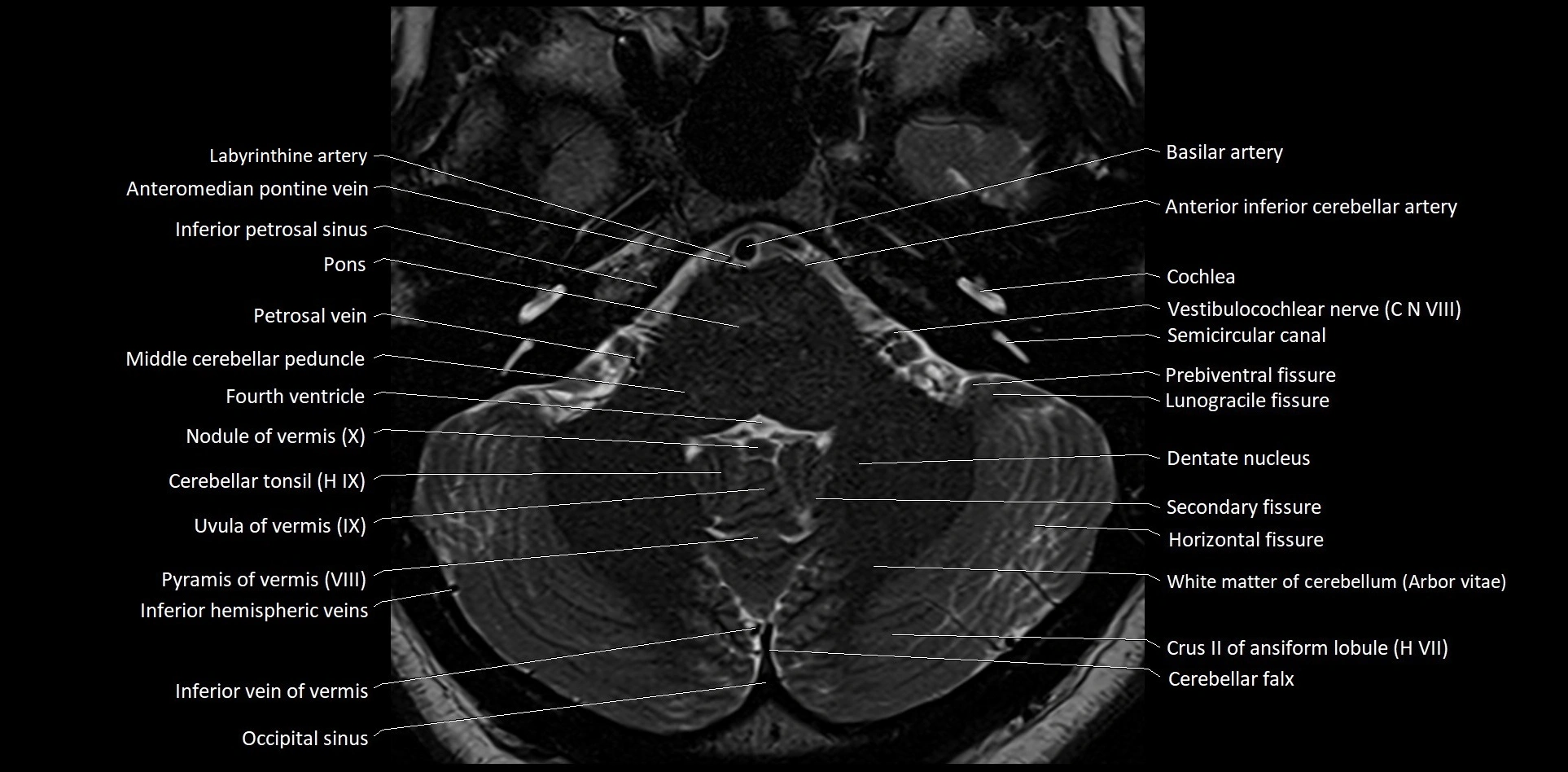 MRI Cerebellar anatomy High-resolution labelled 3T MRI image 11.webp